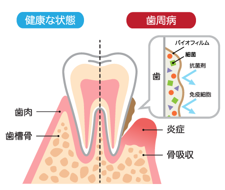 健康な状態と歯周病の歯のイラスト