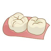 オールセラミックインレーのイラスト