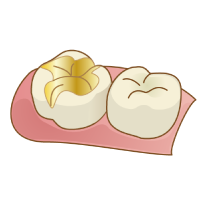 ゴールドインレーのイラスト